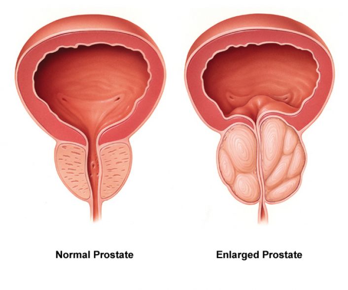 37 year old male enlarged prostate)