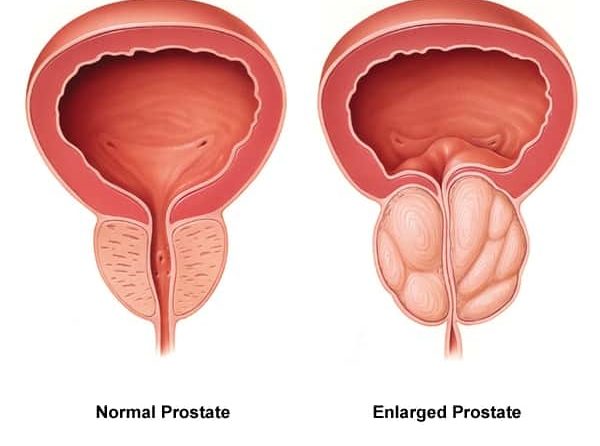 volum normal prostata)